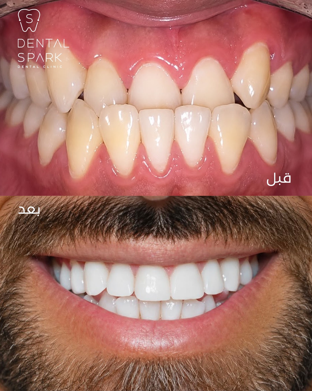 Before and After 2